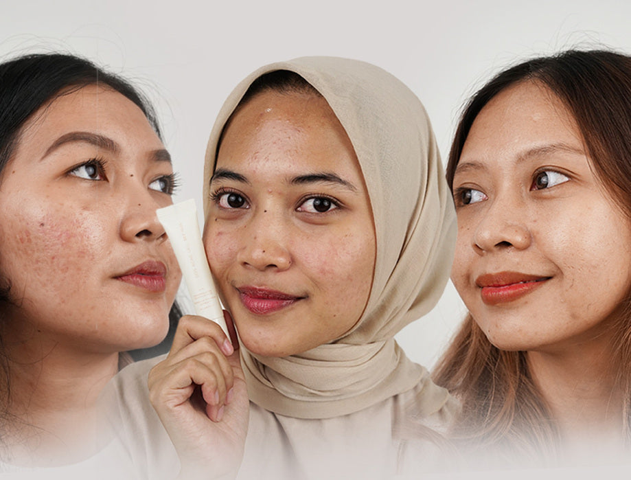 NOW TALKING | JOIN THREE #BLPFAM’S JOURNEY WITH SOS ACNE GEL